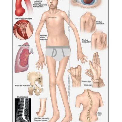 Síndrome de Marfán