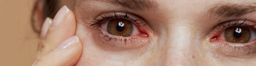 Sindrome de Sjogren