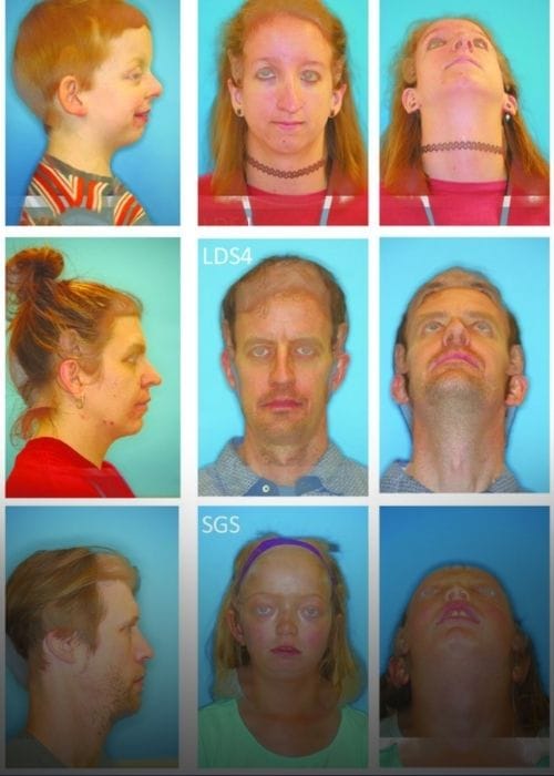 Síndrome de Loeys-Dietz